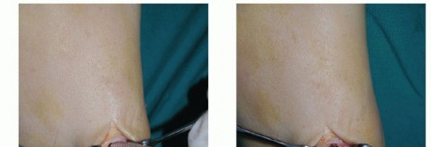 Illustration 58 for Restore Movement: Tendon Transfer for Common Peroneal Nerve Foot Drop