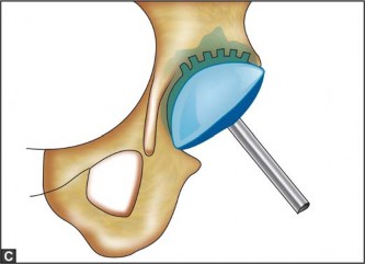 Illustration 23 for Optimizing Acetabular Component Cementation for Superior Outcomes