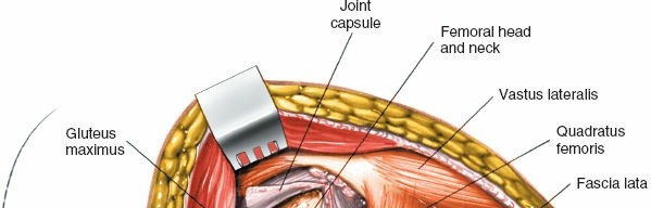 Illustration 187 for Unlocking Every Aspect of the Hip's Surgical Approaches
