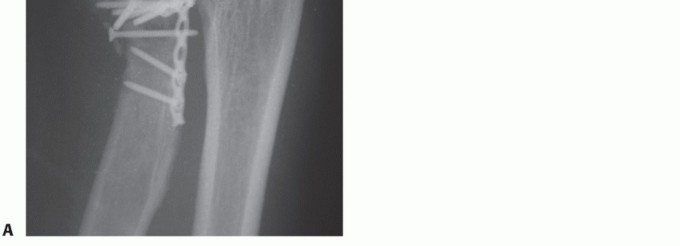 Illustration 47 for Radial Head & Neck Fractures: Mastering ORIF for Best Results