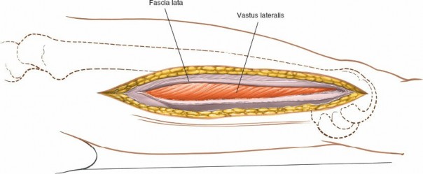Illustration 19 for Optimal Femoral Approaches: Mastering the Lateral Intermuscular Septum
