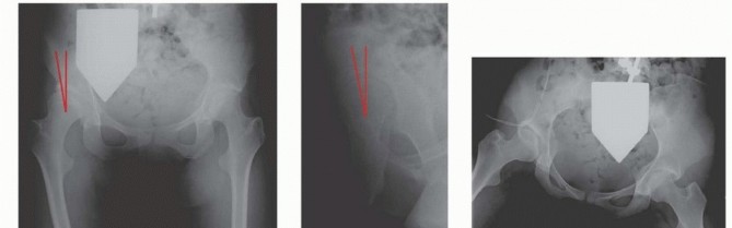Unlock Bernese PAO Precision: fluoroscopic falseprofile view
