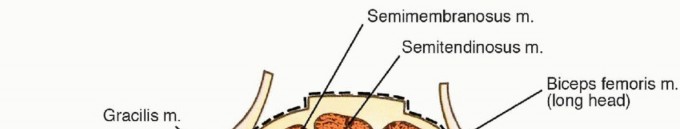 Illustration of posterior thigh resection - Dr. Mohammed Hutaif