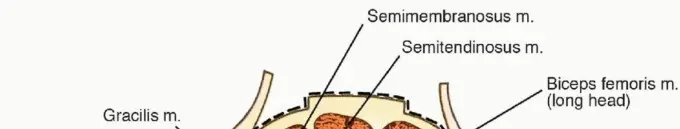 صورة توضيحية لـ استئصال ساركوما الفخذ الخلفي: الحفاظ على الأطراف ونتائج وظيفية مبهرة مع الدكتور محمد هطيف