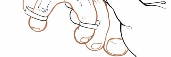 Illustration 227 for Optimized Approaches to the Dorsum of the Foot & Ankle