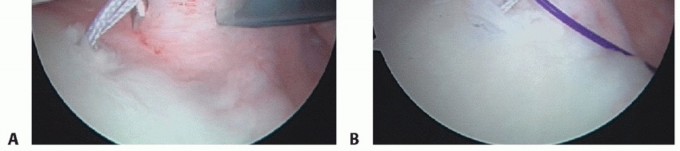 Illustration 7 for Finally Treat Recurrent Posterior Instability of the Shoulder