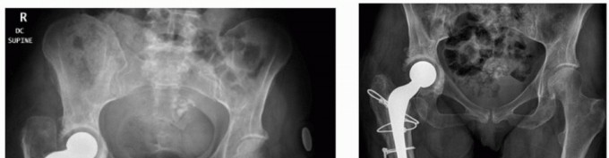 Illustration 7 for PJI of the Hip: Two-Stage Revision: When & How to Prepare