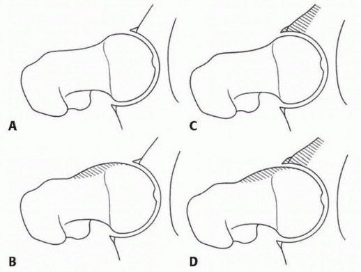 Relieve FAI Pain: Realigning the Femoral Head Center for Lasting Relief