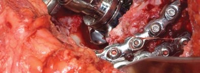 Illustration 52 for Management of Periprosthetic Fractures: An Expert Surgical Guide