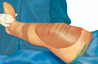 Illustration 9 for Mastering Gap Balancing in Revision TKA: Avoid Common Pitfalls