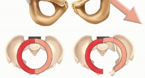 Illustration 7 for Achieve Stable Fixation of the Symphysis: Open Reduction