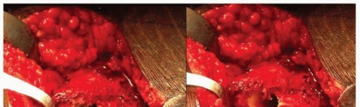 Illustration 10 for Extensively Porouscoated Stems: Proven Success & Superior Fixation