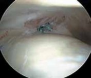 Illustration 29 for Solving Hip Soft Tissue Pathology with Advanced Arthroscopy