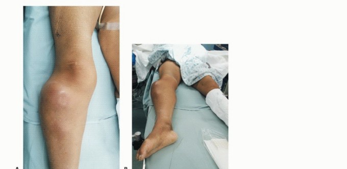 Illustration 9 for Mastering Above-Knee Amputation: Essential Surgical Insights