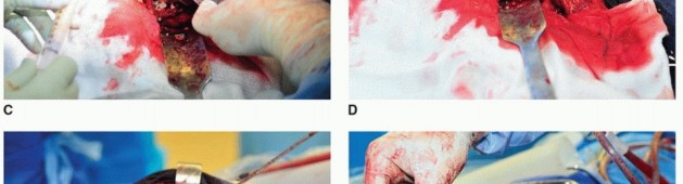 Illustration 35 for Cement in Cement Revision: Simplifying Complex Hip Revisions