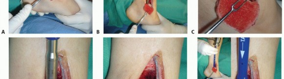 Illustration 27 for Painful Talus Lesions? The tech fig c Osteochondral Transfer Solution