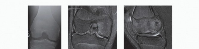 Illustration 29 for Dissecans of the Knee: What's the Difference – OCD vs. AVN?