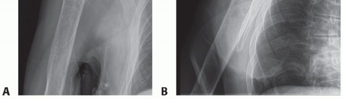 Illustration 4 for Hemiarthroplasty for Proximal: Effective Treatment for Fractures