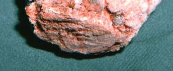 Illustration 6 for Expert Bone Grafting for Primary Total Hip Replacement Success