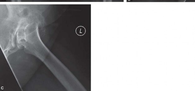 Illustration 152 for Successful Total Hip Replacement in Developmental Dysplasia