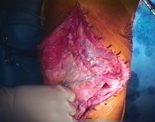 Illustration 10 for Extensor Reconstruction in Total Knee Arthroplasty: Essential Strategies