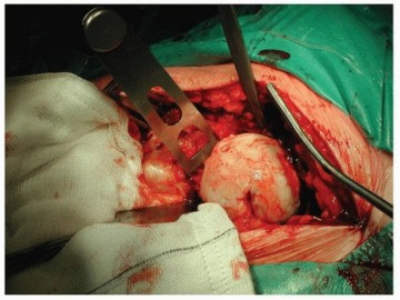 Illustration 3 for Why Polished Tapered Cemented Stems Excel in Hip Replacement