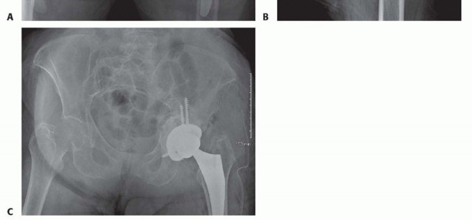 Illustration 19 for Total Hip Arthroplasty: Journey to Preventing Complications