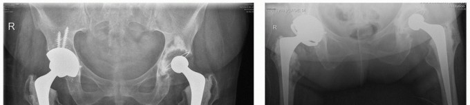 Illustration 52 for Cement in Cement Revision: Simplifying Complex Hip Revisions