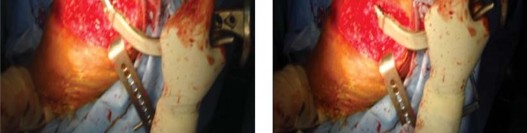 Illustration 8 for The Proxima: Why This Proximally Loading Implant Preserves Bone