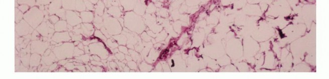 Illustration 30 for Precision Biopsy of Musculoskeletal Tumors for Accurate Diagnosis