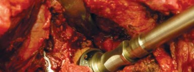 Illustration 50 for Navigating Early THA for Fractures of the Acetabulum