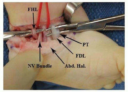 Illustration 10 for Resistant Clubfoot Solved: Posteromedial and Posterolateral Release