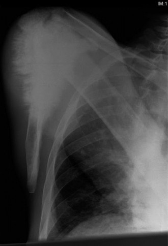 Oncology Cases Osteosarcoma: Essential Orthopedic Insights