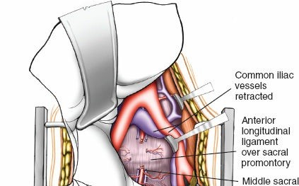 Illustration 92 for Approach to the Lumbar Spine: Mastering Techniques & Anatomy