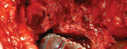 Illustration 109 for Femoral Stem Revision: Posterior Approach for Better Outcomes