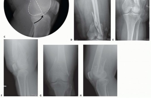 Illustration 11 for Repairing Distal Femur Fractures: Open Reduction & Internal Fixation