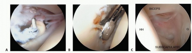 Illustration 13 for Stiff Shoulder? Discover Arthroscopic Capsular Release Solutions
