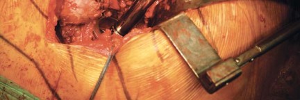 Illustration 26 for Metal on Metal Resurfacing: Enhanced Posterior Soft Tissue Repair