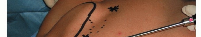 Illustration 15 for Is Your Dorsal Scapular Nerve Causing Snapping Scapula Pain?