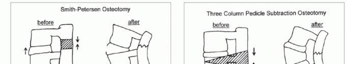 Mastering Pedicle Subtraction Osteotomy: Techniques & Anatomy