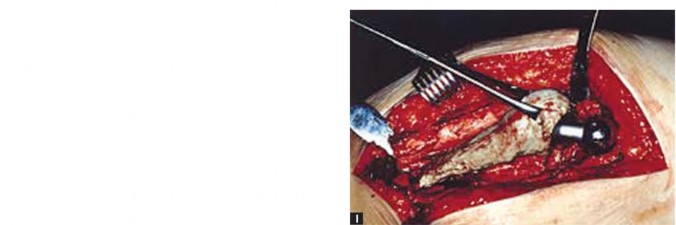 Illustration 18 for Standard Trochanteric Osteotomy: Key to Complex Hip Cases