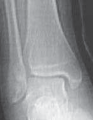 Illustration 25 for Pediatric Ankle Fractures: Management to Prevent Long-Term Issues
