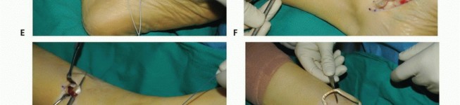 Illustration 27 for Foot Drop Surgery: How a Pin or Drill Elevates Tendon Transfer