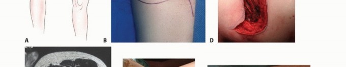 Illustration 38 for Precision Biopsy of Musculoskeletal Tumors for Accurate Diagnosis