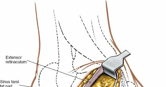 Illustration 107 for Optimized Approaches to the Dorsum of the Foot & Ankle
