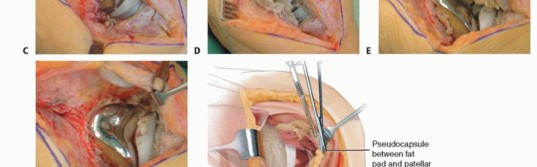 Illustration 7 for Tibial Tubercle Osteotomy: The Key to Extensile Exposure in Revision TKA