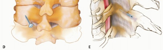 Illustration 22 for Achieve Stability: Posterior Cervical Lateral Mass Screw Fusion