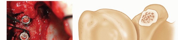 Illustration 23 for Glenoid Bone Graft for Anterior Shoulder Instability: Restore Stability