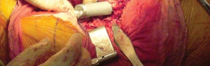 Illustration 21 for Effective Arthroplasty for Salvage of Failed Hip Fixation