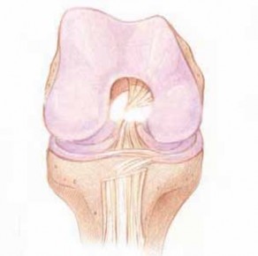 Illustration 15 for Optimizing Single-Bundle Anterior Cruciate Ligament Repair
